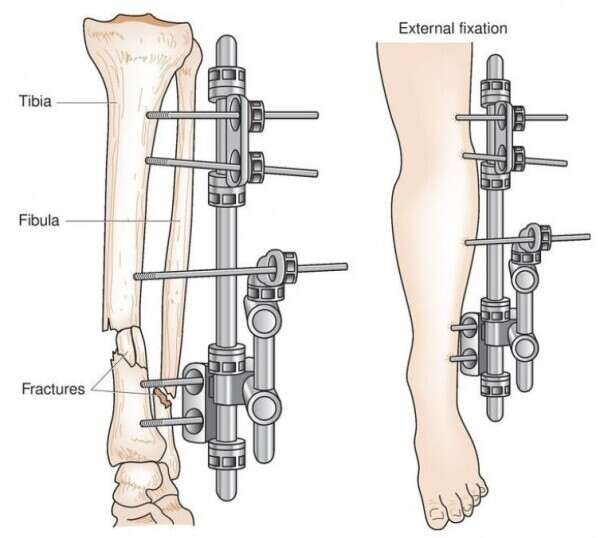 External Fixation Devices MED Institute