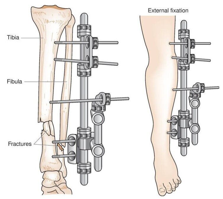 Cross Ankle External Fixation External Fixators Inter vrogue.co